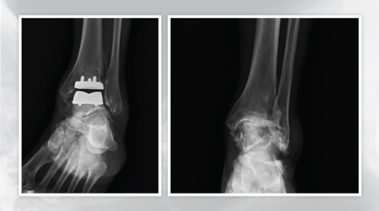 Total ankle replacement at UOA